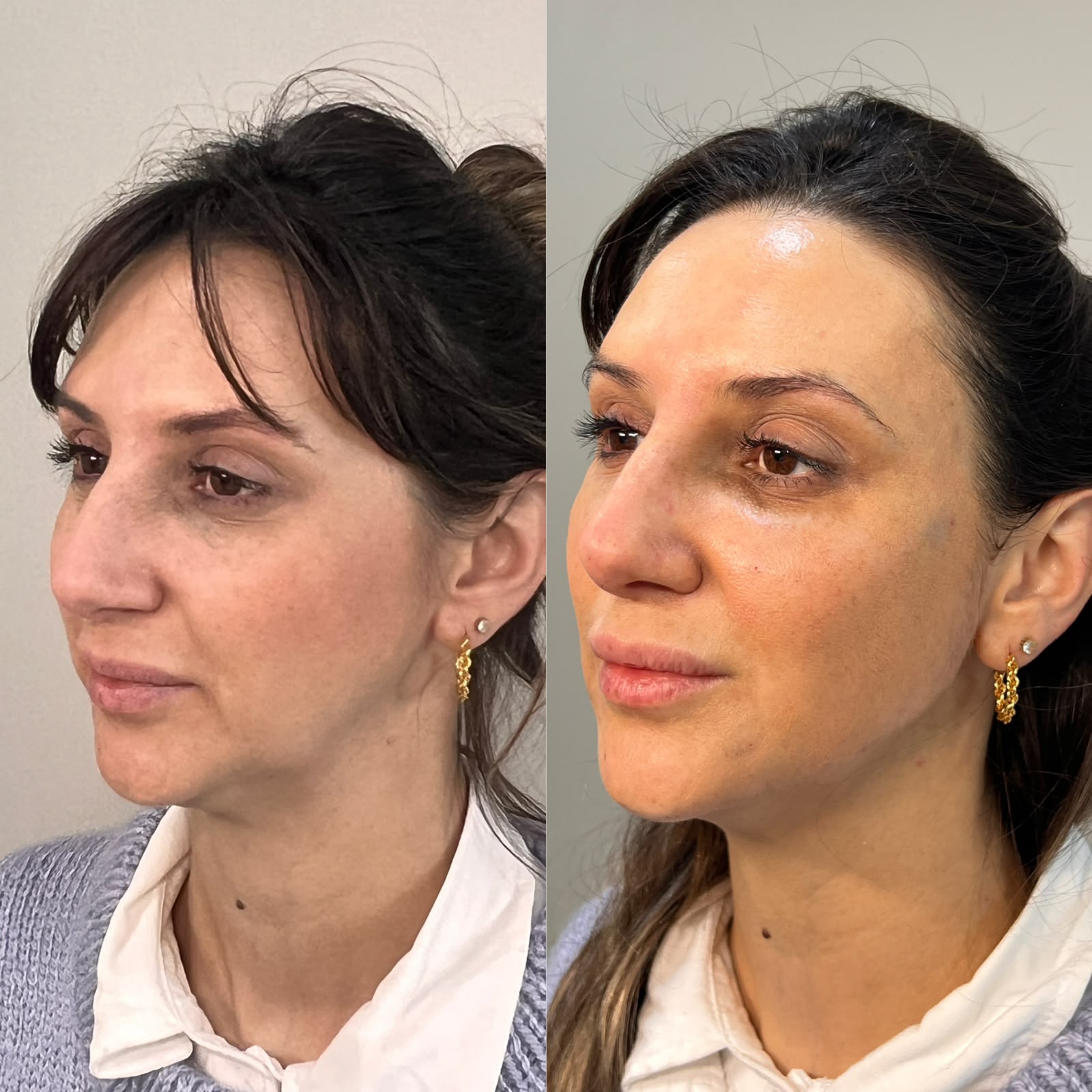 Comparativo de resultado de perfil facial feminino