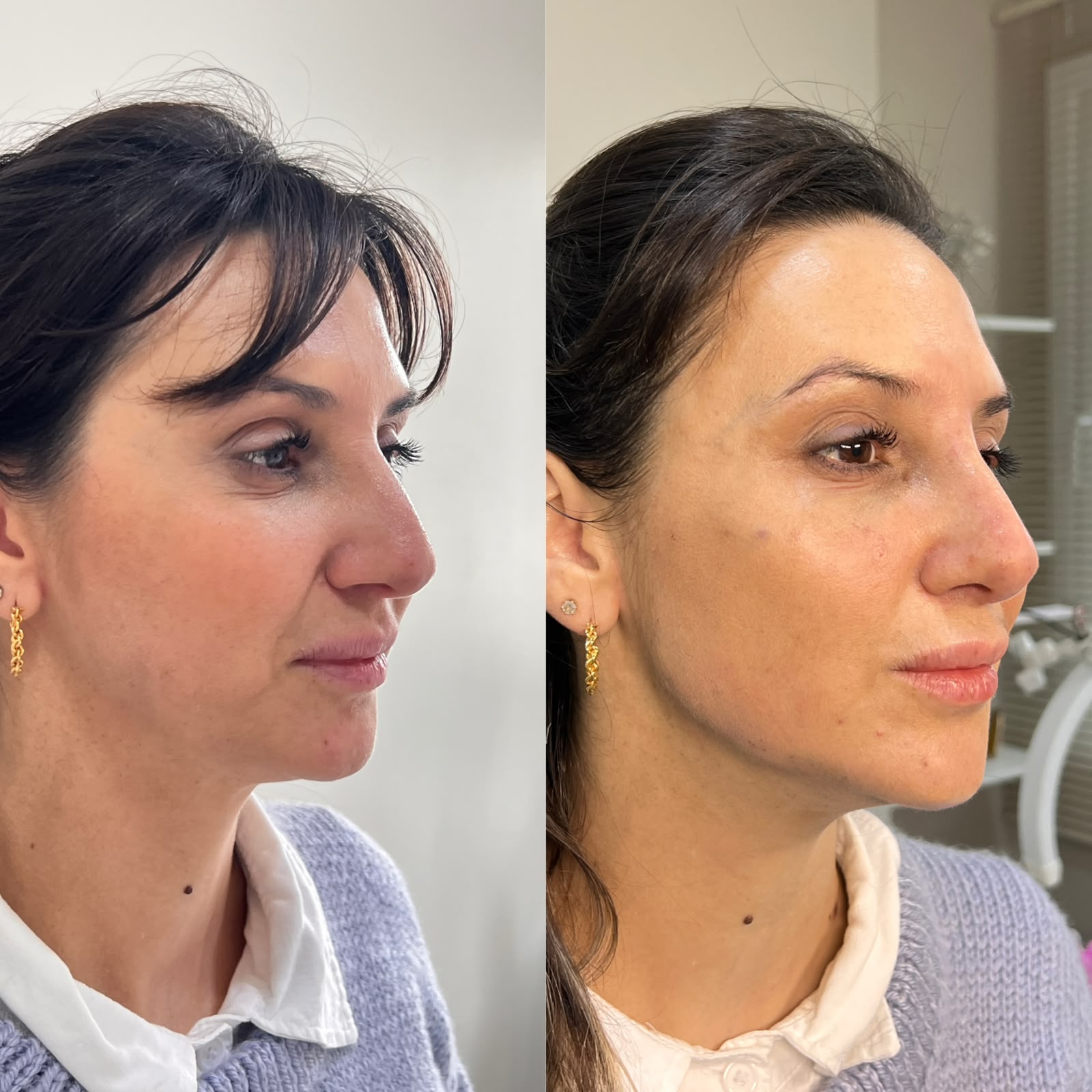 Comparativo de resultado de perfil facial feminino