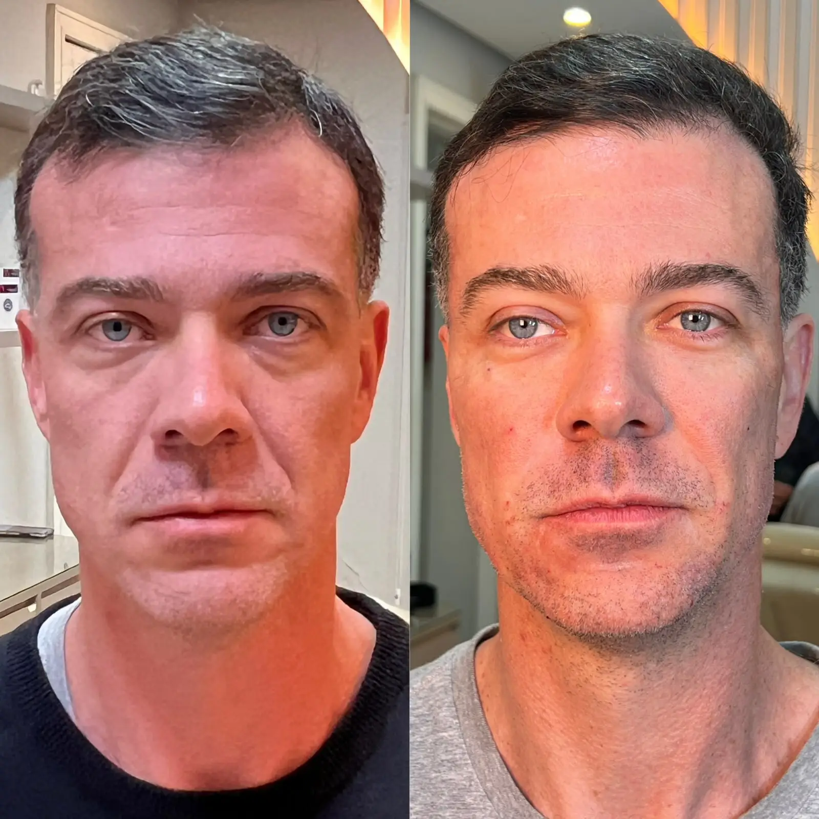 Comparativo de resultado facial masculino em visão frontal