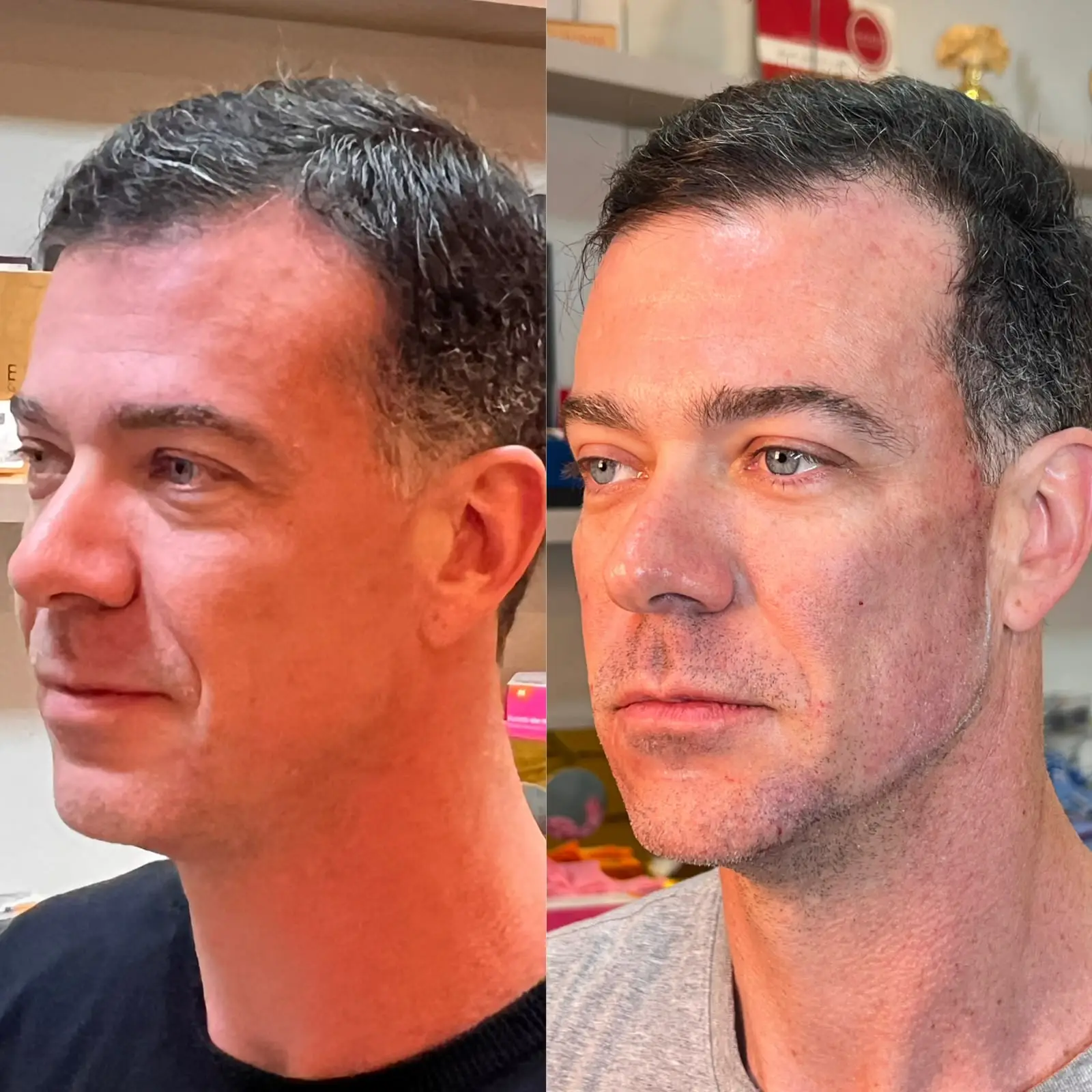 Comparativo de resultado facial masculino em visão lateral