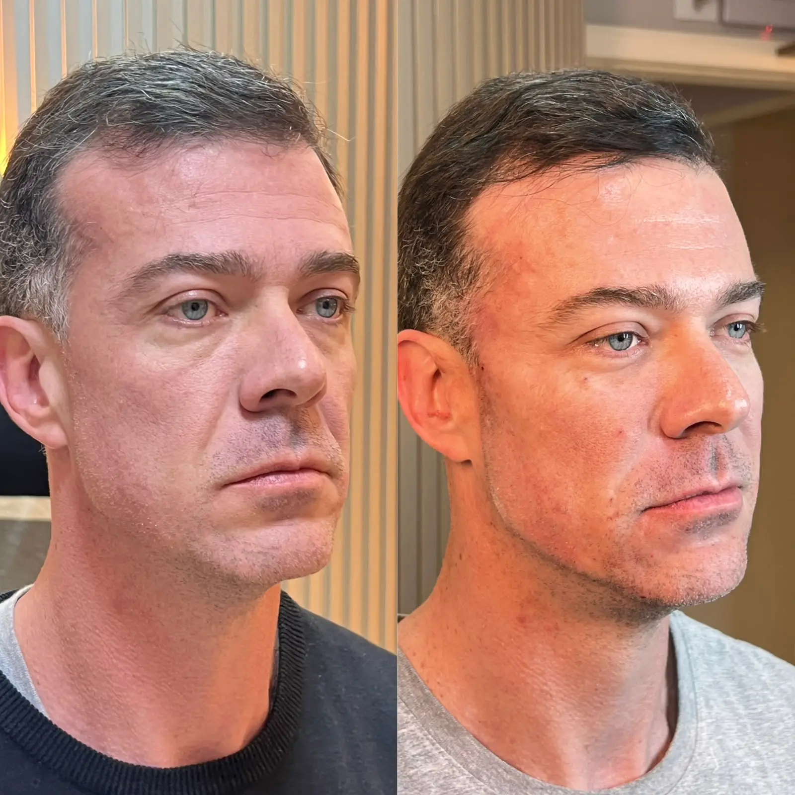 Comparativo de resultado facial masculino em ângulo de três quartos