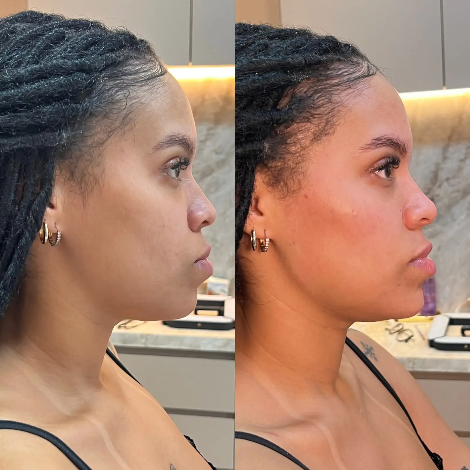 Comparativo de resultado de perfil facial feminino