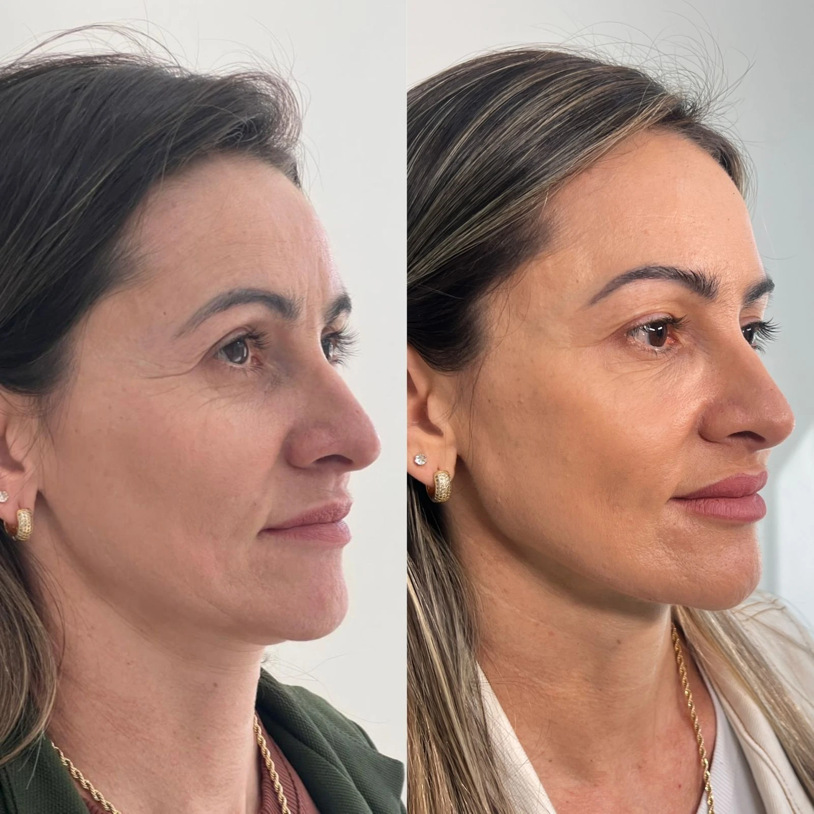 Comparativo de resultado de perfil facial feminino