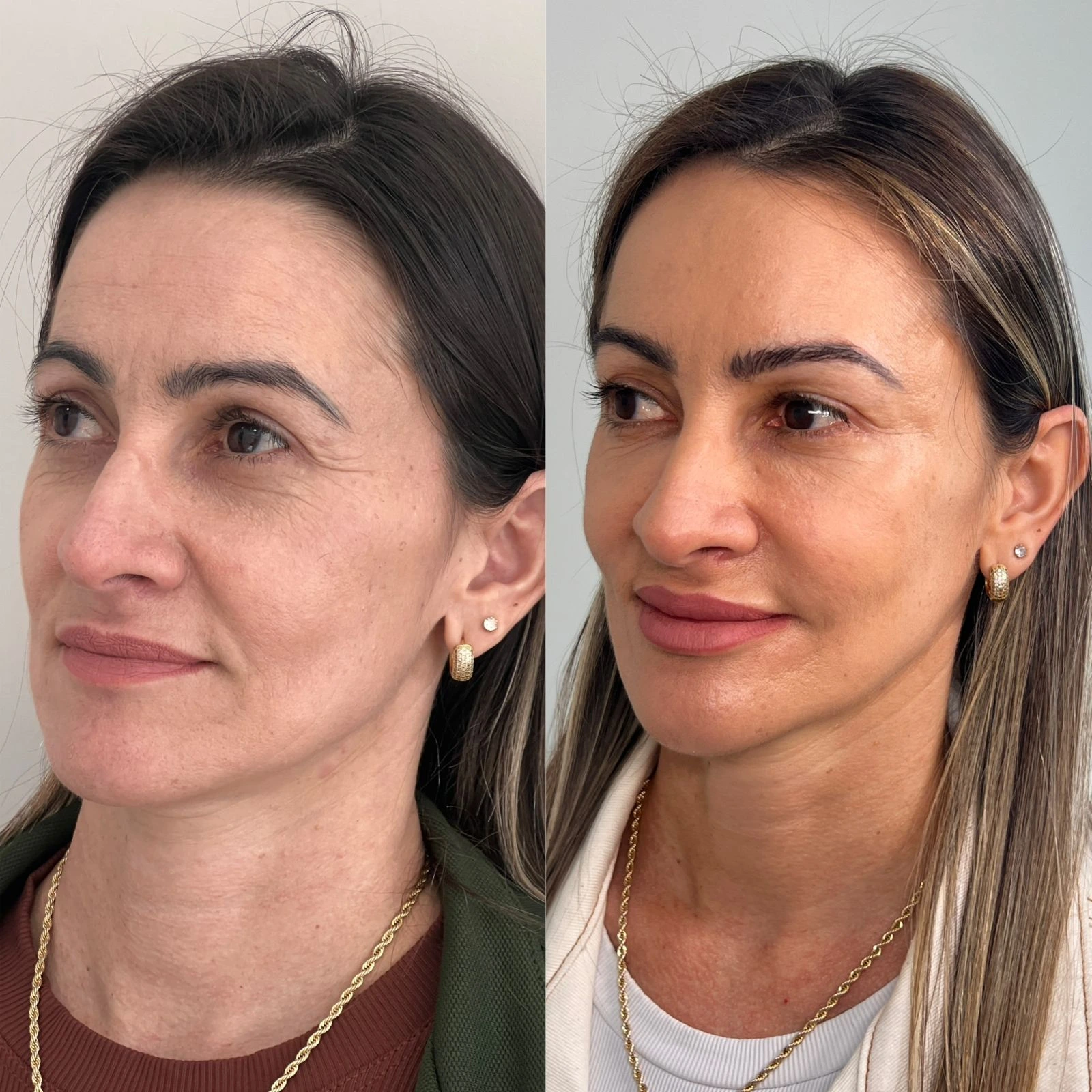 Comparativo de resultado de perfil facial feminino