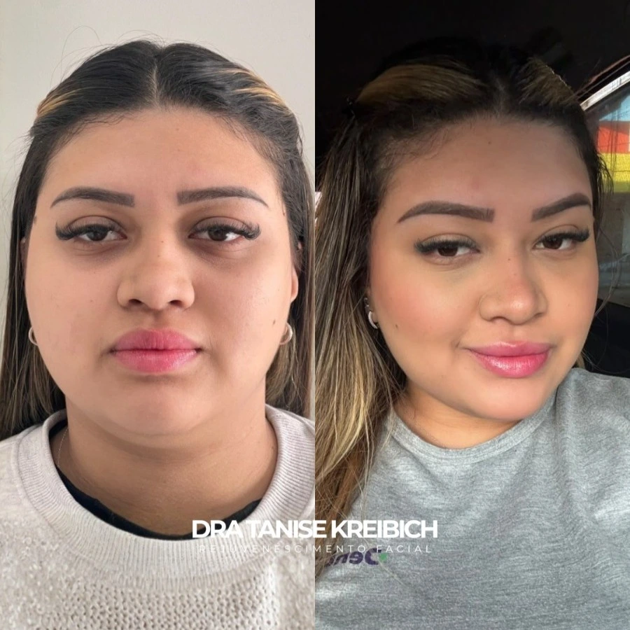 Comparativo de resultado de perfil facial feminino